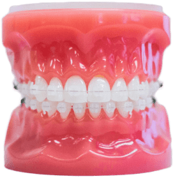 illustration about best Clear Braces at Pediatric Dentistry and Orthodontics of Forsyth - Cumming in Cumming, GA.