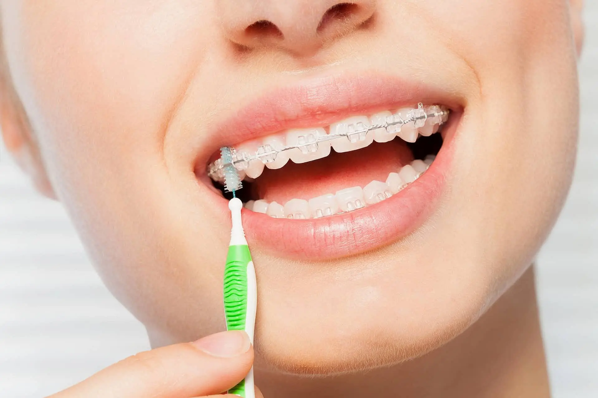 An interdental brush cleans around clear braces at Pediatric Dentistry and Orthodontics of Forsyth - Cumming in Cumming, GA.