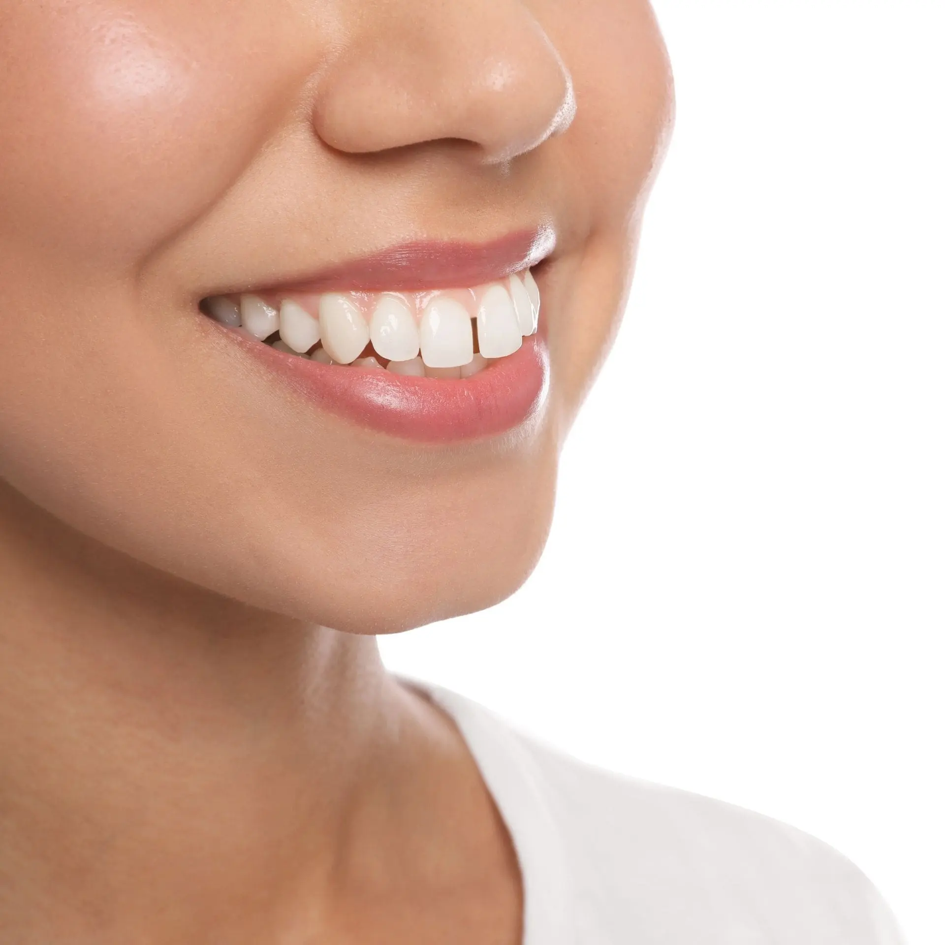 A bright smile with white teeth and smooth skin, representing need overbite treatment at Forsyth Pediatric Dentistry and Orthodontics in Cumming, GA.