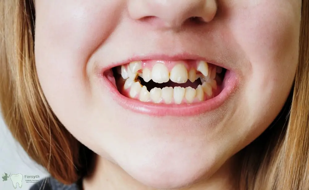 A close-up of a smiling mouth with uneven, crowded teeth and gaps, promoting Forsyth Pediatric Dentistry and Orthodontics in Cumming, GA - How to Prevent Baby Bottle Decay in Cumming, GA 